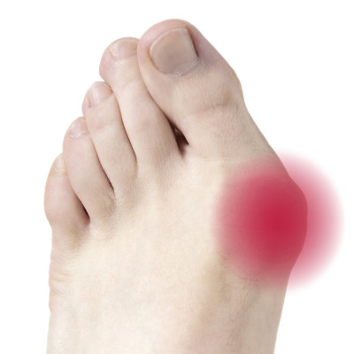 Гелевий протектор на великий палець Vitamed 5th Toe Gel Bunion Pad Гелевий протектор на великий палець Vitamed 5th Toe Gel Bunion Pad фотографія 3