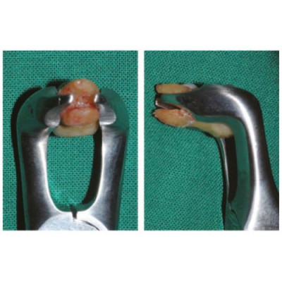 Легкие щипцы EASY FORCEPS 3253 Легкие щипцы EASY FORCEPS 3253 фото 7
